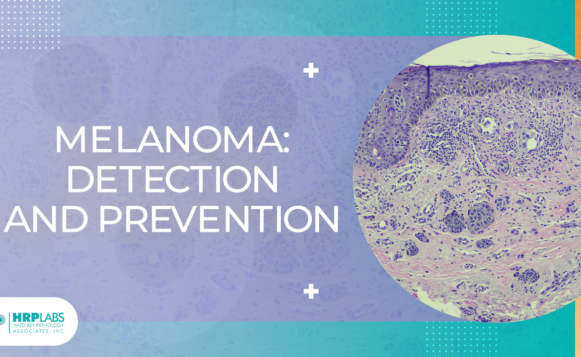 Melanoma: Detection and Prevention